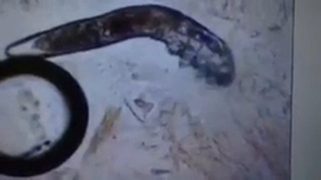 Live Demodex Mites Test смотреть онлайн