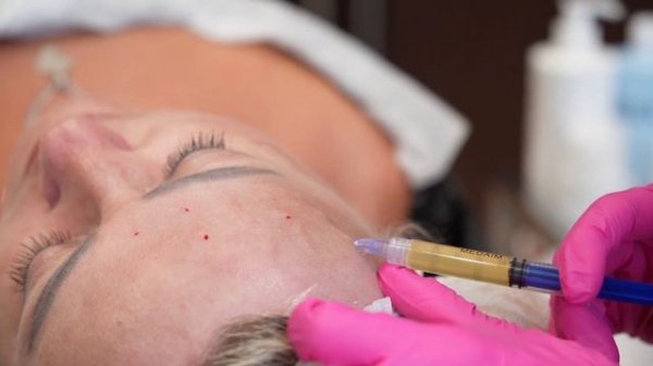 Плазмалифтинг на аппарате CORTEXIL PRP в центре баланса красоты и здоровья Time4me