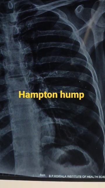 Hampton hump in pulmonary embolism (chest xray of pulmonary embolism): wedge shaped infarct смотреть онлайн