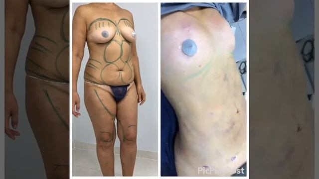 Липомоделирование смотреть онлайн