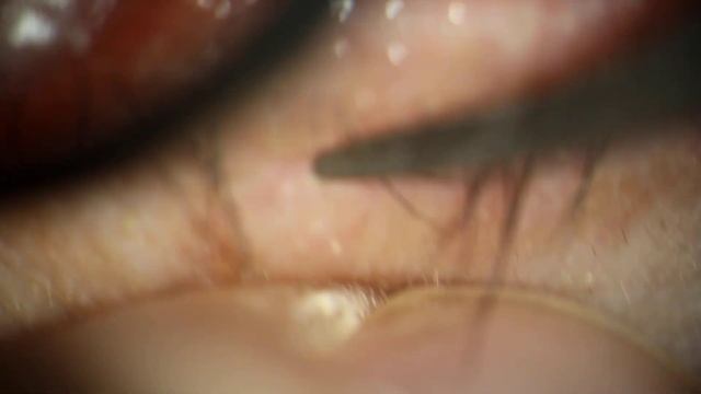 Demodex Excrement Papilloma Scraped off of Eyelid смотреть онлайн