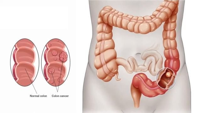 Colon Cancer Signs And Symptoms And Causes (Urdu/Hindi) | Bari Aant Ka Cancer