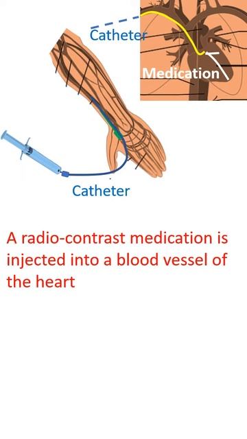 How is an angiogram done? смотреть онлайн