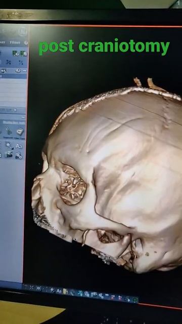 post craniotomy images#ctscan #brain #headshot #mri #craniotomy #surgery смотреть онлайн