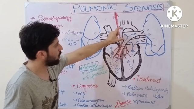 pulmonary stenosis | valvular, sub and supravalvular | pathophysiology, symptoms and treatment смотреть онлайн