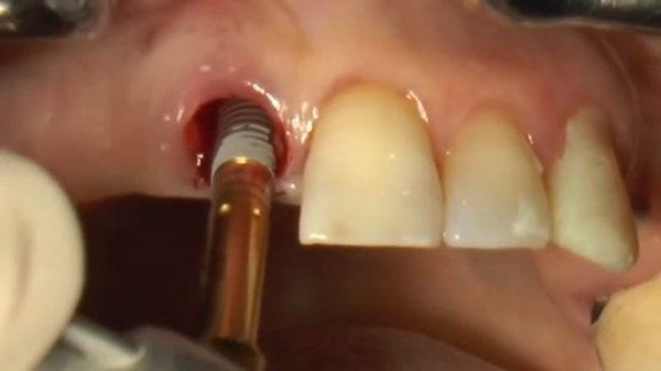 Immediate implant placement using the Neodent implant system.