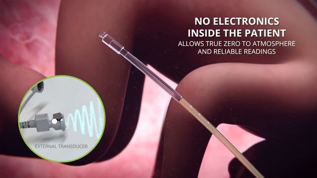 Koala® Intrauterine Pressure Catheter Animation