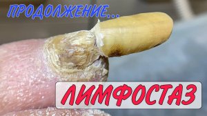 Лимфостаз _ скрученные ногти _ медицинский педикюр