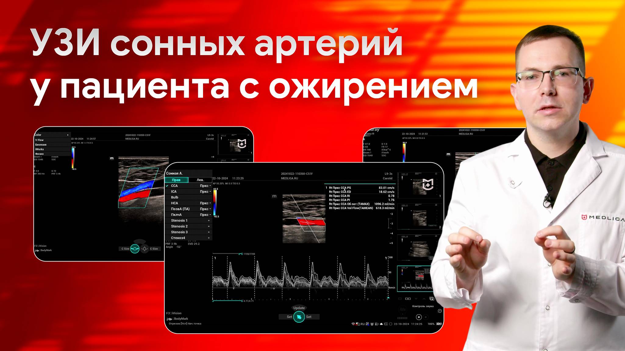 УЗИ сонных артерий у пациента с ожирением на Mindray Resona i9 смотреть онлайн