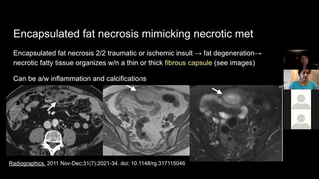 Fat Necrosis Mimicking Peritoneal Implant - Dr. Nelly Tan