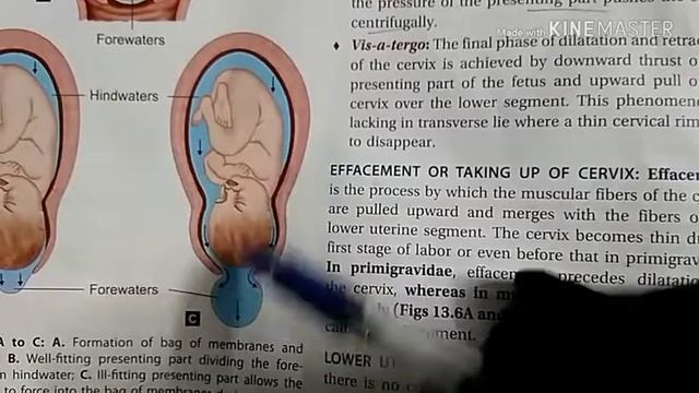 Stages of labor @EASY LEARNING смотреть онлайн