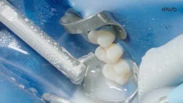 Клиническом применении RONDOflex Plus 360.