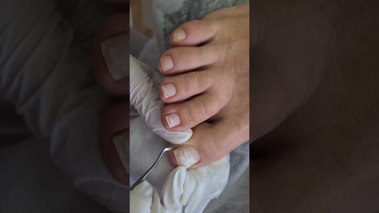 Вот почему нельзя перенашивать покрытие на ногах! Пленки для ногтей. Аппаратный педикюр смотреть онлайн