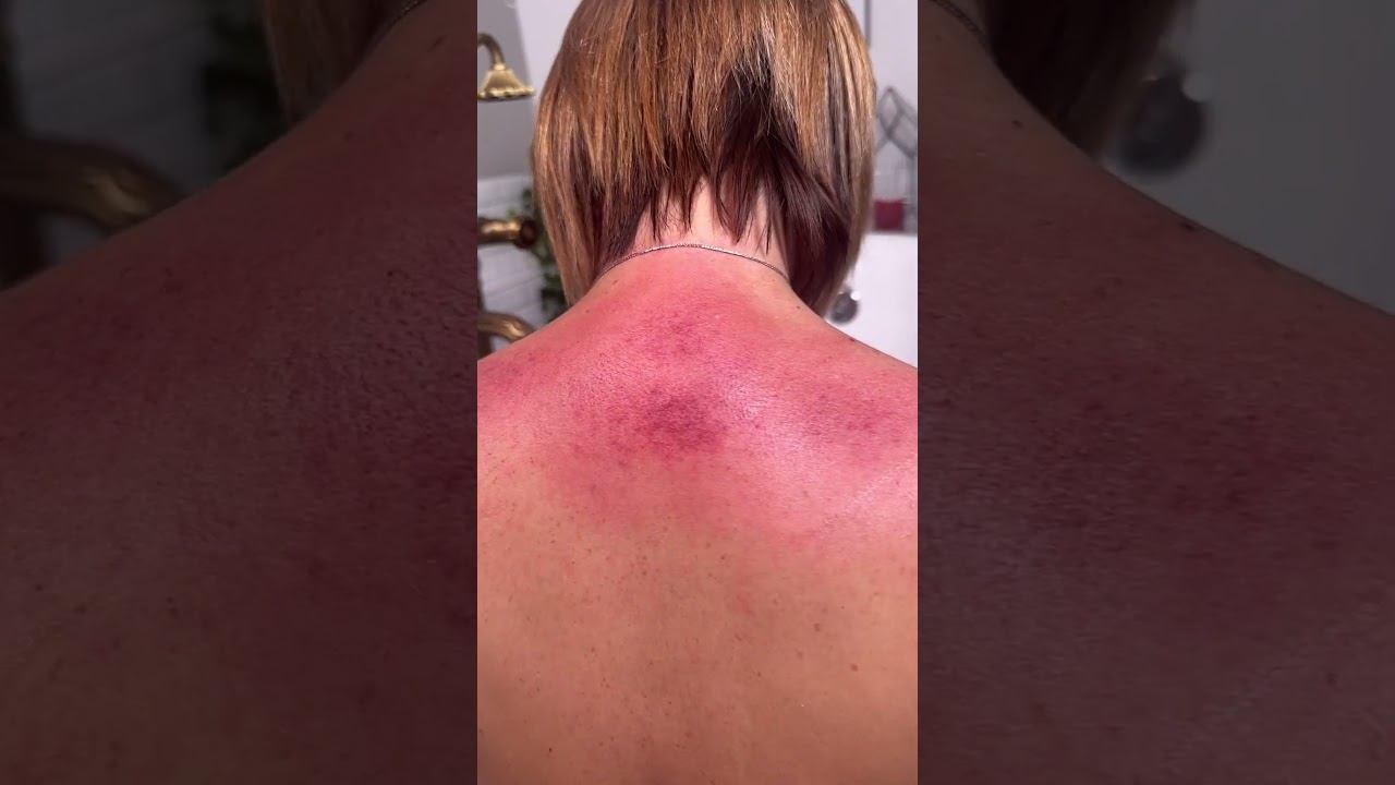 Холка? Боль в шее? Смотри видео о том, как устранить холку и избавиться от боли в шее #shorts смотреть онлайн