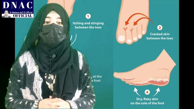 tinea pedis / fungal foot / athlete foot / stinging fingers / rashes at toe / fungal diseases смотреть онлайн