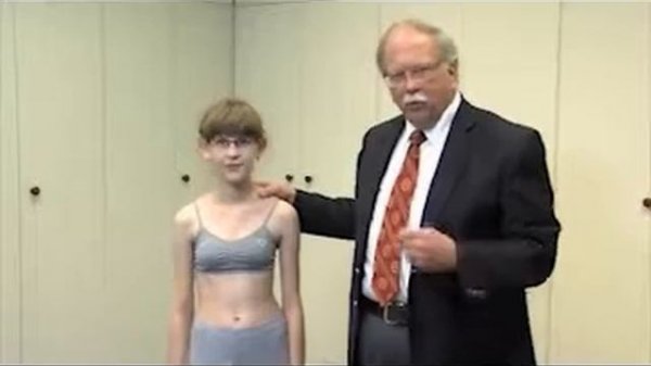 SRS Patient Video: Diagnosing Scoliosis - John R. Dimar II, MD