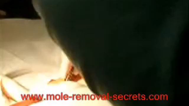 Mole Surgery Alternative смотреть онлайн