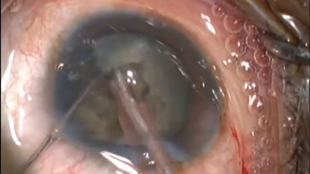 High myopia at lowest bottle height смотреть онлайн