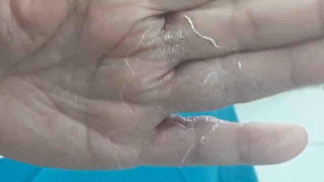 Tinea Corporis mother+son смотреть онлайн