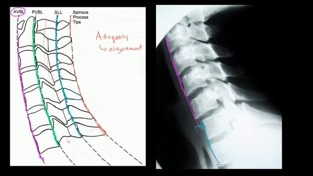 Assessing alignment of the lateral cervical spine (neck) X-ray | Heatlh & Medicine | Khan Academy смотреть онлайн