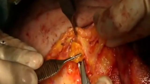 Комок Биша - Removal of facial lumps by Dr. Shurgaya смотреть онлайн