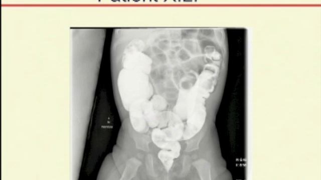 Intussusception смотреть онлайн