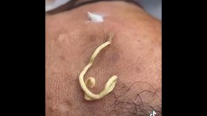 выдавливание прыщей | выдавливание чёрных точек