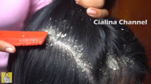 Long Hair Combing, Extreme Damage - Dandruff Shampoo and Huge Flake Scratching #760