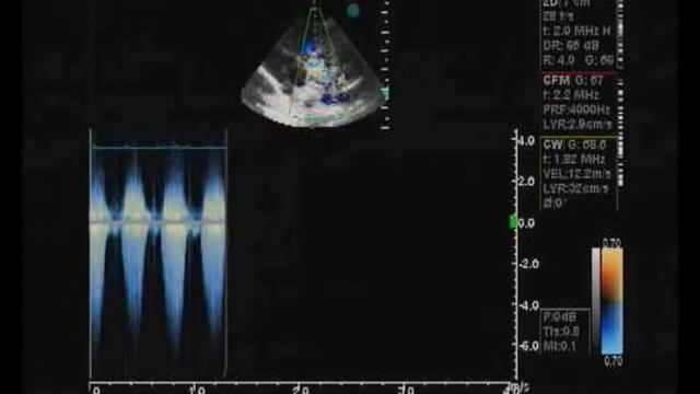 echocardiogram of severe pulmonary stenosis смотреть онлайн