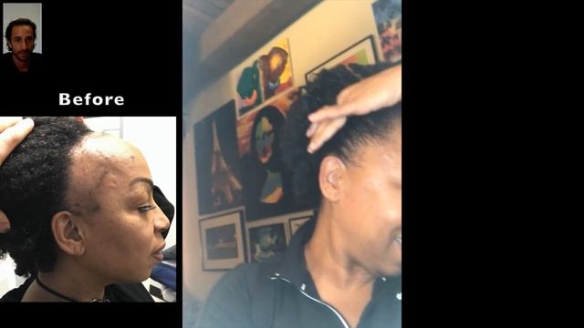 Traction Alopecia 12 Months Hair Transplants Results | Dr. Blumenthal (Alena) смотреть онлайн
