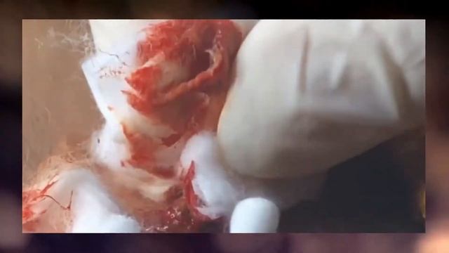 Milia easy way to removed the biggest acne from your face смотреть онлайн