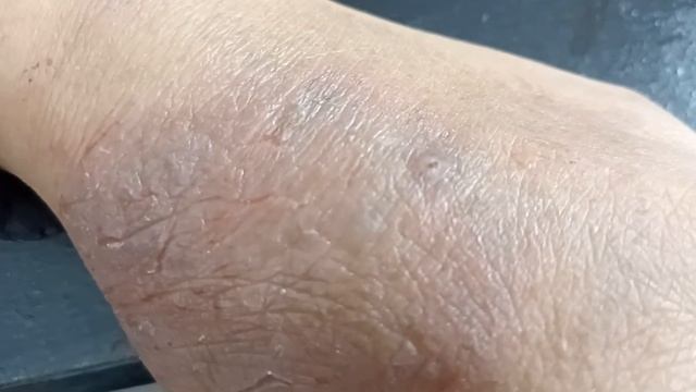 Primary Tinea incognito on hand disseminating to face. Hand fissuring due to steroid cream usage смотреть онлайн