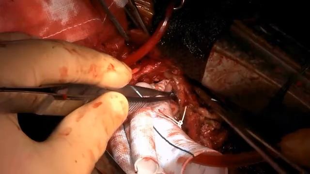 Asvide: A case report of valve-sparing aortic root replacement in a patient with full metal jacket. смотреть онлайн