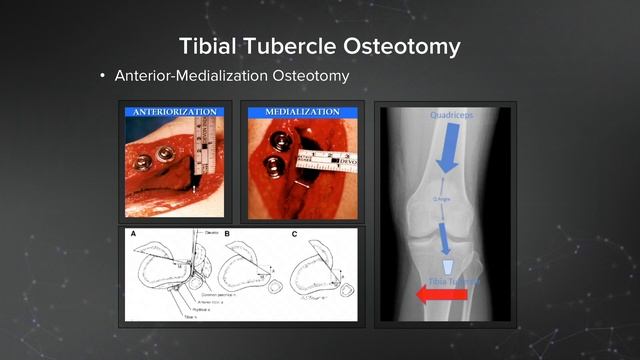 Treatment Considerations for Patellofemoral Arthroplasty смотреть онлайн