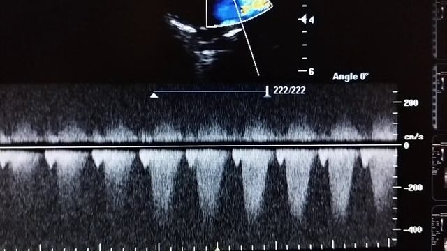 Congenital Isolated Pulmonary Stenosis - severe in a young infant with respiratory distress. смотреть онлайн