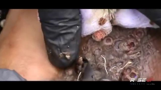 Huge Foot Infection and Cyst #3 смотреть онлайн
