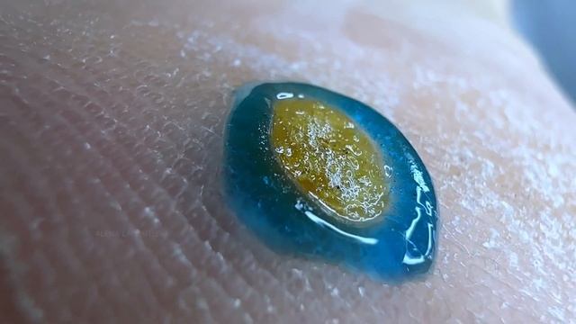 КРАСИВАЯ БОРОДАВКА #аленалаврентьева #подолог #подология #обучениеподологии #бородавка