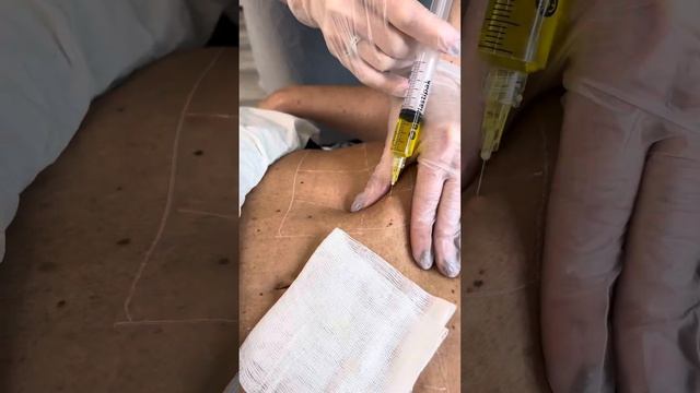 Lemon Bottle Fat Dissolving