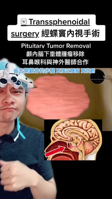 與 @dr sayf #合拍 經蝶竇內視鏡腦下垂體腫瘤切除手術 #耳鼻喉科 #神經外科 #otolaryngologist #neurosurgery #pituitarytumor #shorts смотреть онлайн