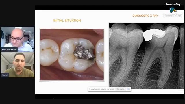 With Talal : Dr Karrar Salah Alhosny : Posterior composite restorations. Episode 9 смотреть онлайн