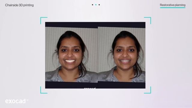The power of iTero Element™ 5D Plus imaging systems in cosmetic dentistry смотреть онлайн