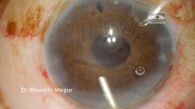 The Iris Claw Lens, in a case of traumatic Subluxated Cataract смотреть онлайн