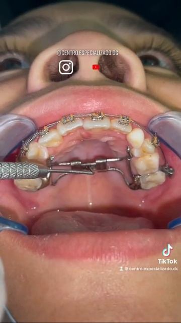 ¿Expanzor Dental? смотреть онлайн