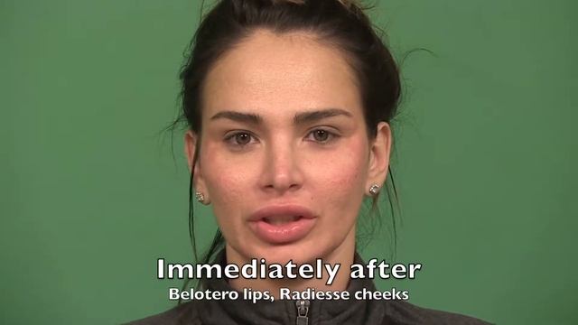 Radiesse cheeks Belotero Lips A смотреть онлайн