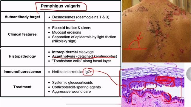 Pemphigus vulgaris _ in one Slide смотреть онлайн