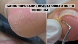 ARAVIA. Педикюр на проблемных ногах. Тампонирование кополином и смарт педикюр диском.