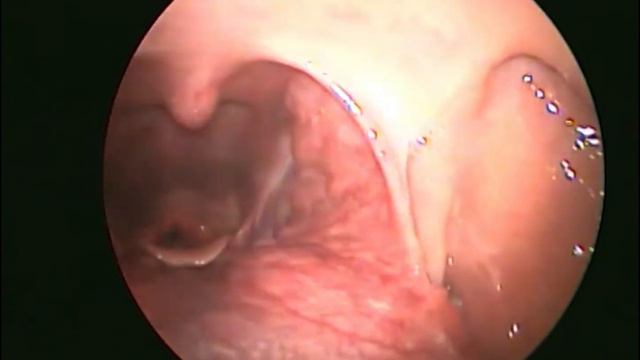 Throat endoscopy - Laryngoscopy : How i do it смотреть онлайн