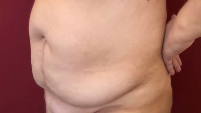 Абдоминопластика Киев Dr. Varsik смотреть онлайн