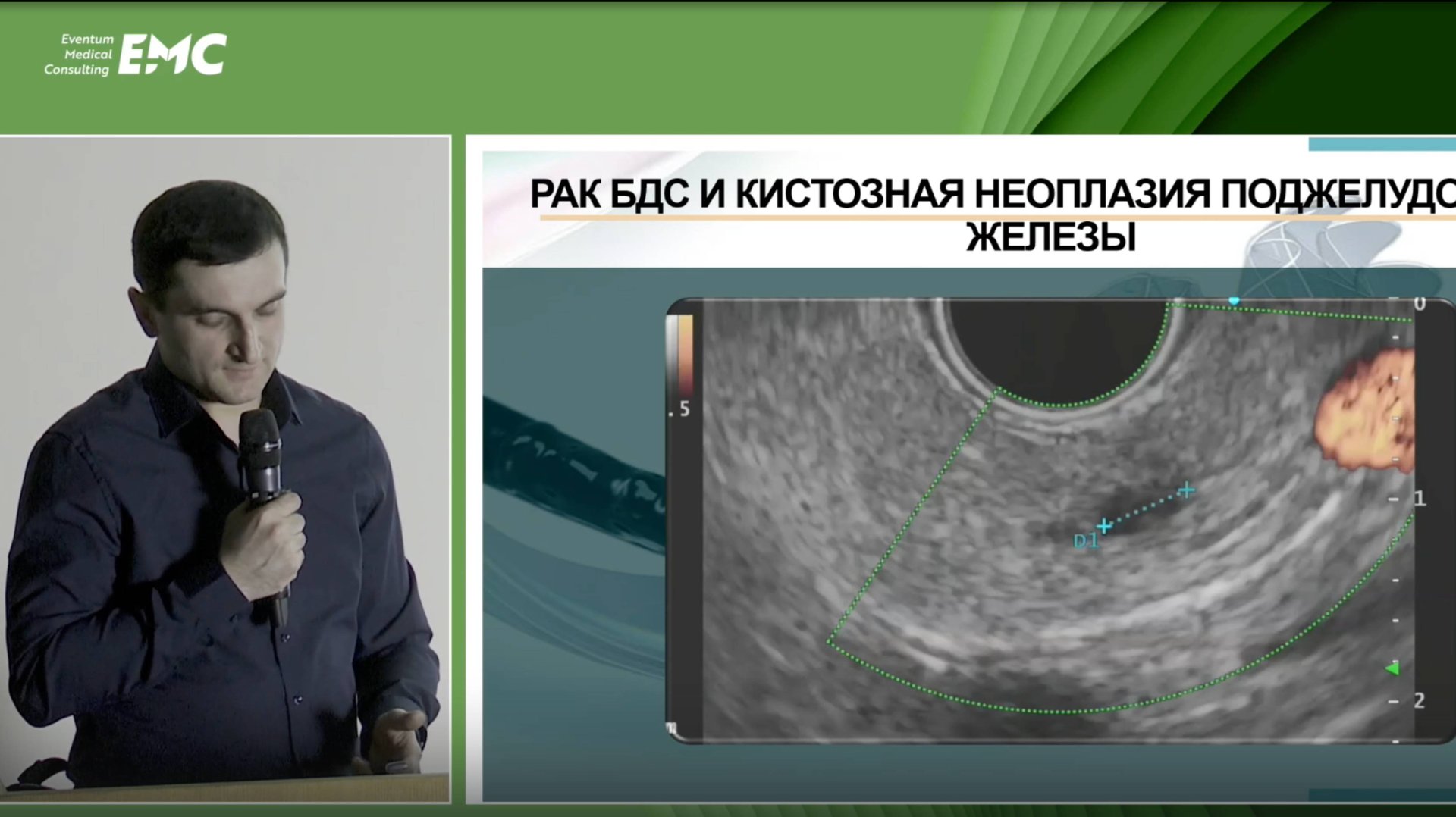 6 Алиев НА Диагностическая эндосонография панкреатобилиарной зоны: что мы обычно упускаем из вида
