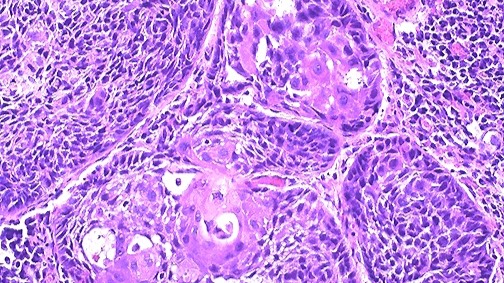 Хронические заболевания и опухоли лёгких смотреть онлайн